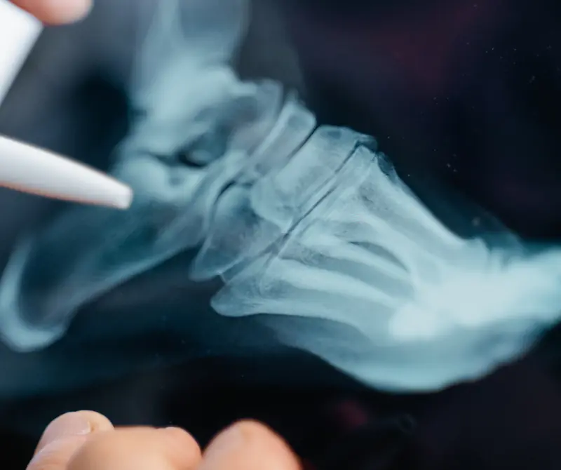 Radiografia digitale del piede in refertazione